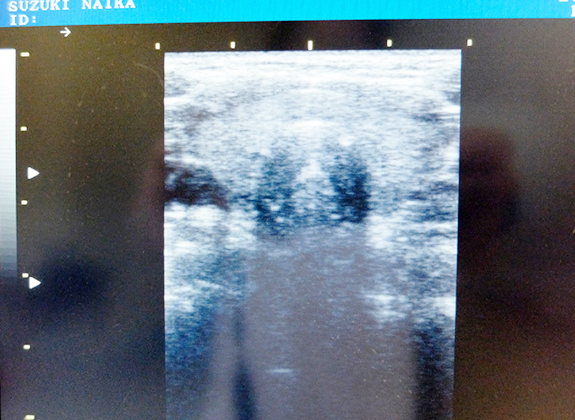 4 甲状腺内分泌疾患